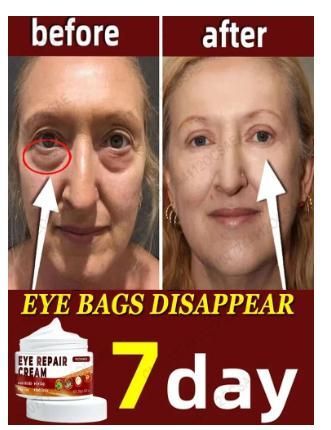 Eye Bags Removal Cream - Under Eye Cream